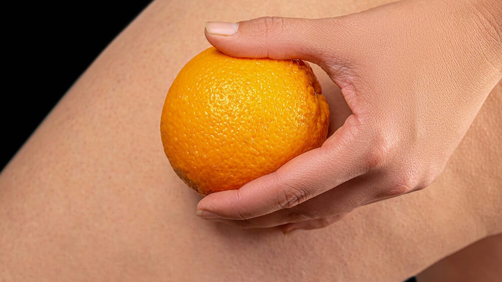Comment perdre de la cellulite
